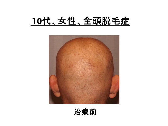 円形脱毛症　病院""